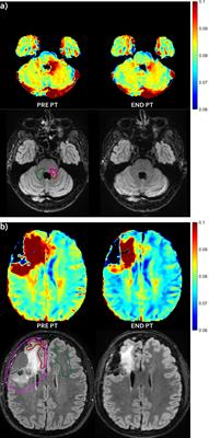 Quantitative Multicomponent T2 Relaxation Showed Greater Sensitivity Than Flair Imaging to Detect Subtle Alterations at the Periphery of Lower Grade Gliomas